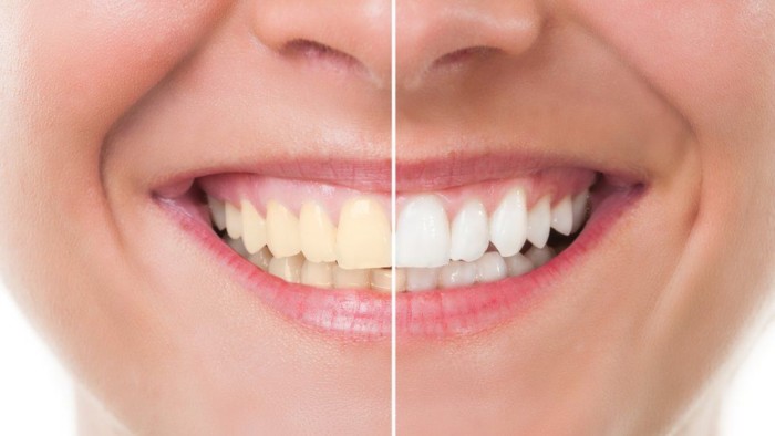 ‘Dangerous’ home teeth whitening kits sold online