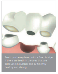 a solution to missing teeth